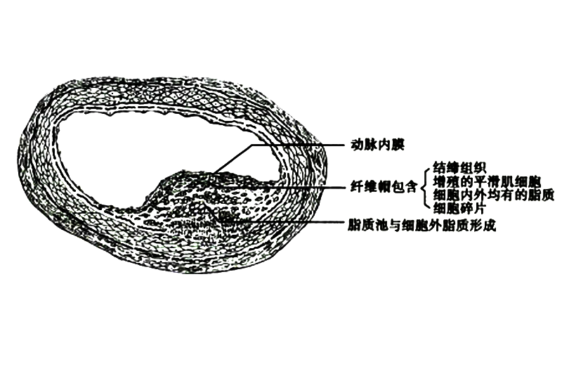 血脂系列：心脑血管疾病的危险因子——Lp-PLA2